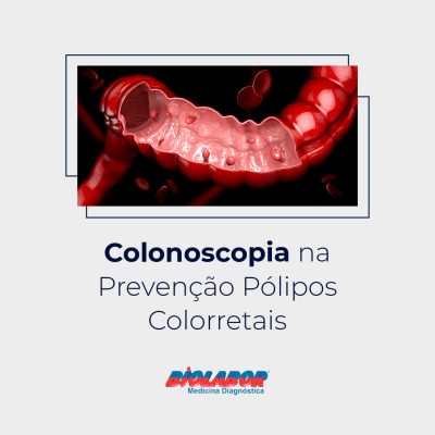 colonoscopia-na-prevencao-polipos-colorretais